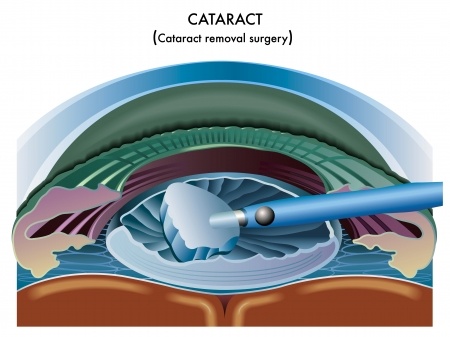 Cataracts Cataracts Orange County CA