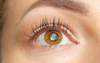 south-cal-eye- what-do-cataracts-look-like