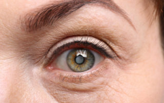 south-cal-eye- can-cataracts-come-back-after-surgery