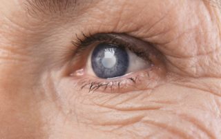 SCEC-cataracts-and-blindness-can-vision-loss-be-reversed